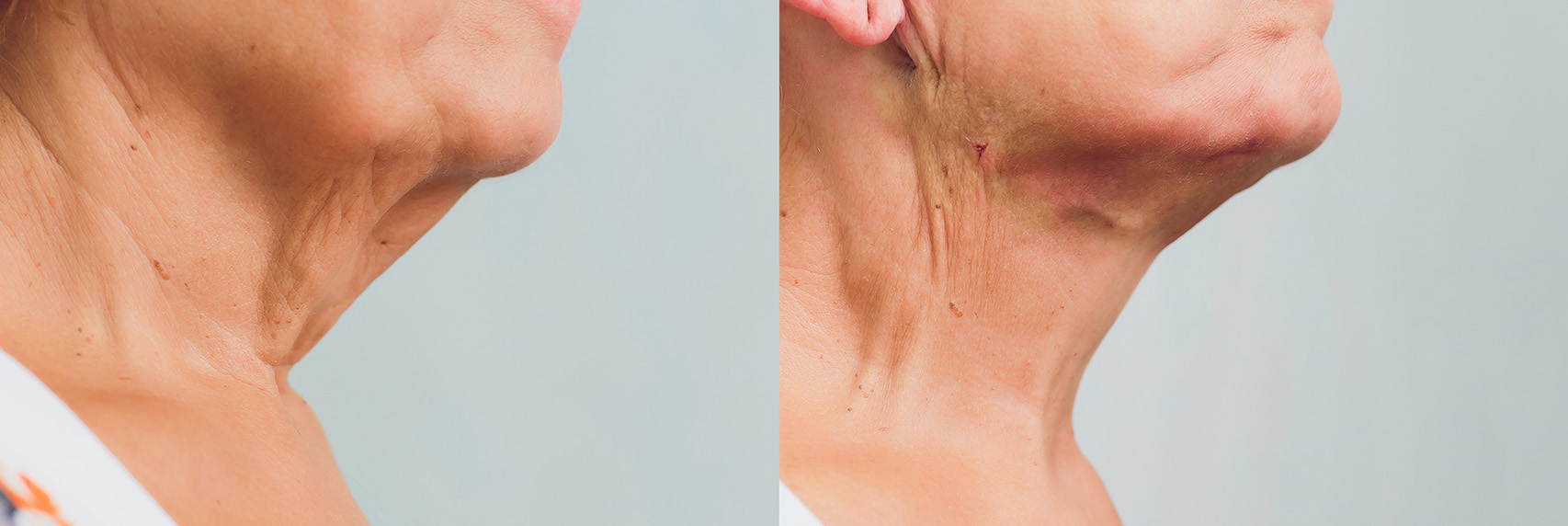 a before and after picture set. the image on the left displays a woman with loose sagging jowl skin. the image on the right displays two tiny surgical spots indicative of threading where the sagging jowl skin was lifted and now has a tighter more youthful appearance.