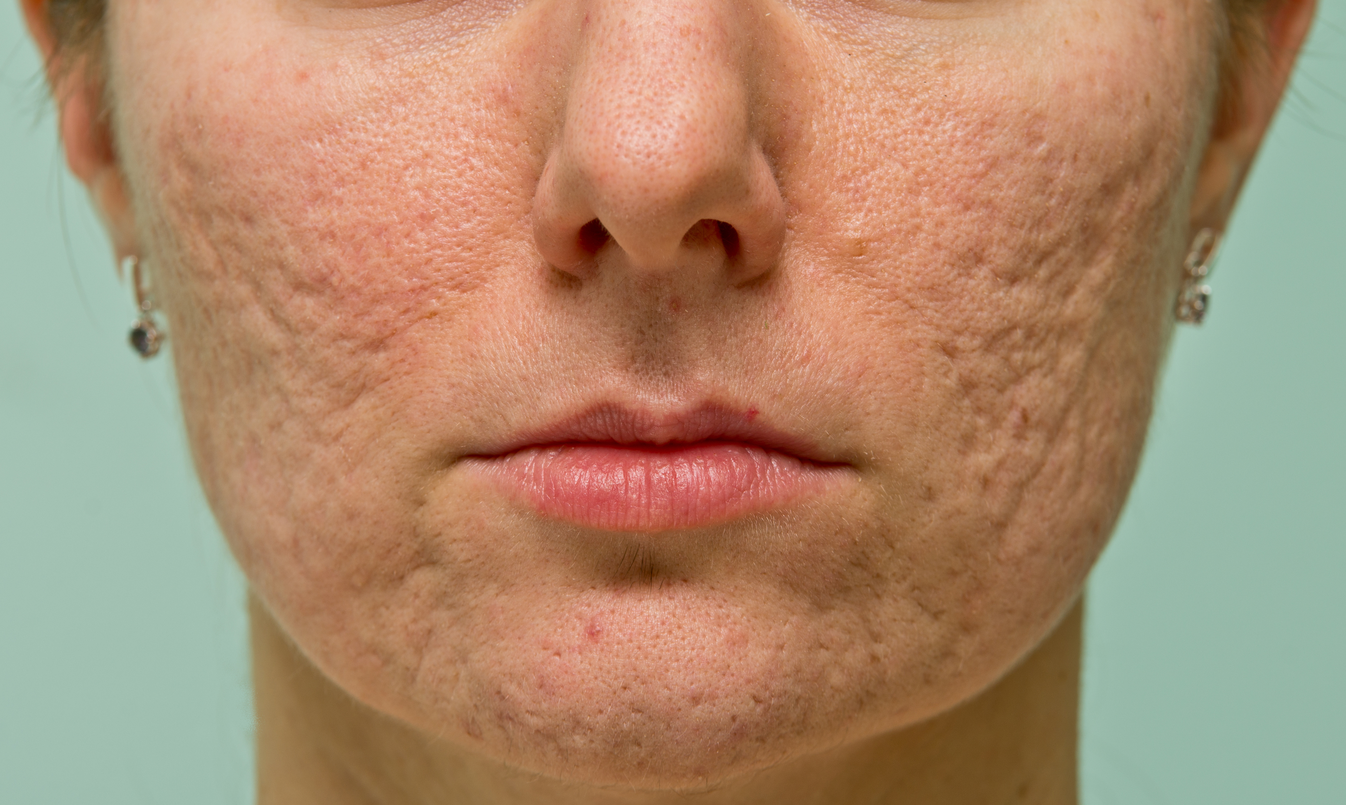 a picture of a woman from her nose down with facial skin appearing to be scarred by acne