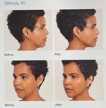 woman with before and after profile pictures reflecting the difference after having radiesse injections to improve her jawline